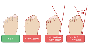Bunions Uncovered Can cause Discomforts and therefore the Best and newest Treatments
